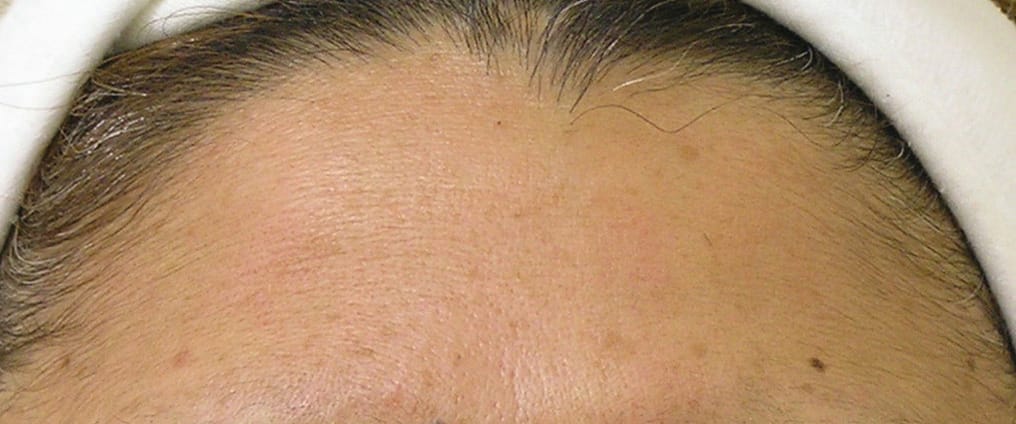 След процедури Hydrafacial