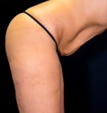 Преди процедура с NuEra Tight