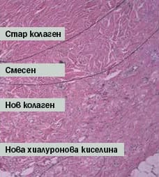 неоколагенеза Profound