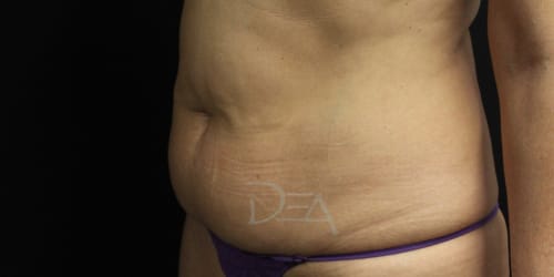 Lanluma Before