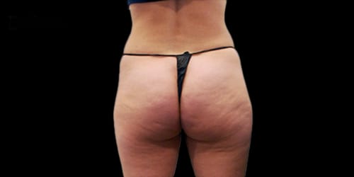 Lanluma Before