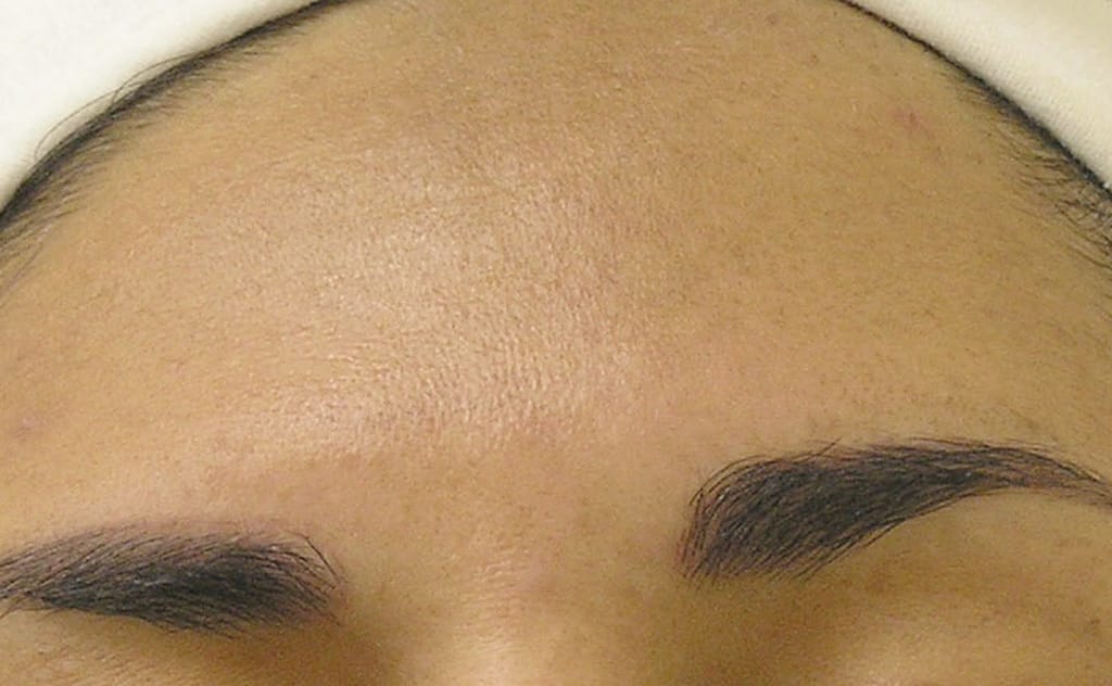 След процедури Hydrafacial