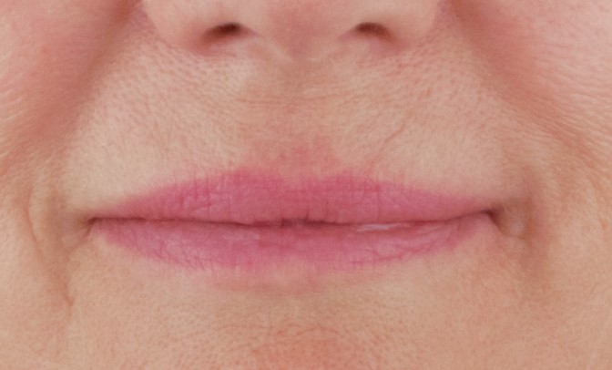 Frax lip rejuvenation